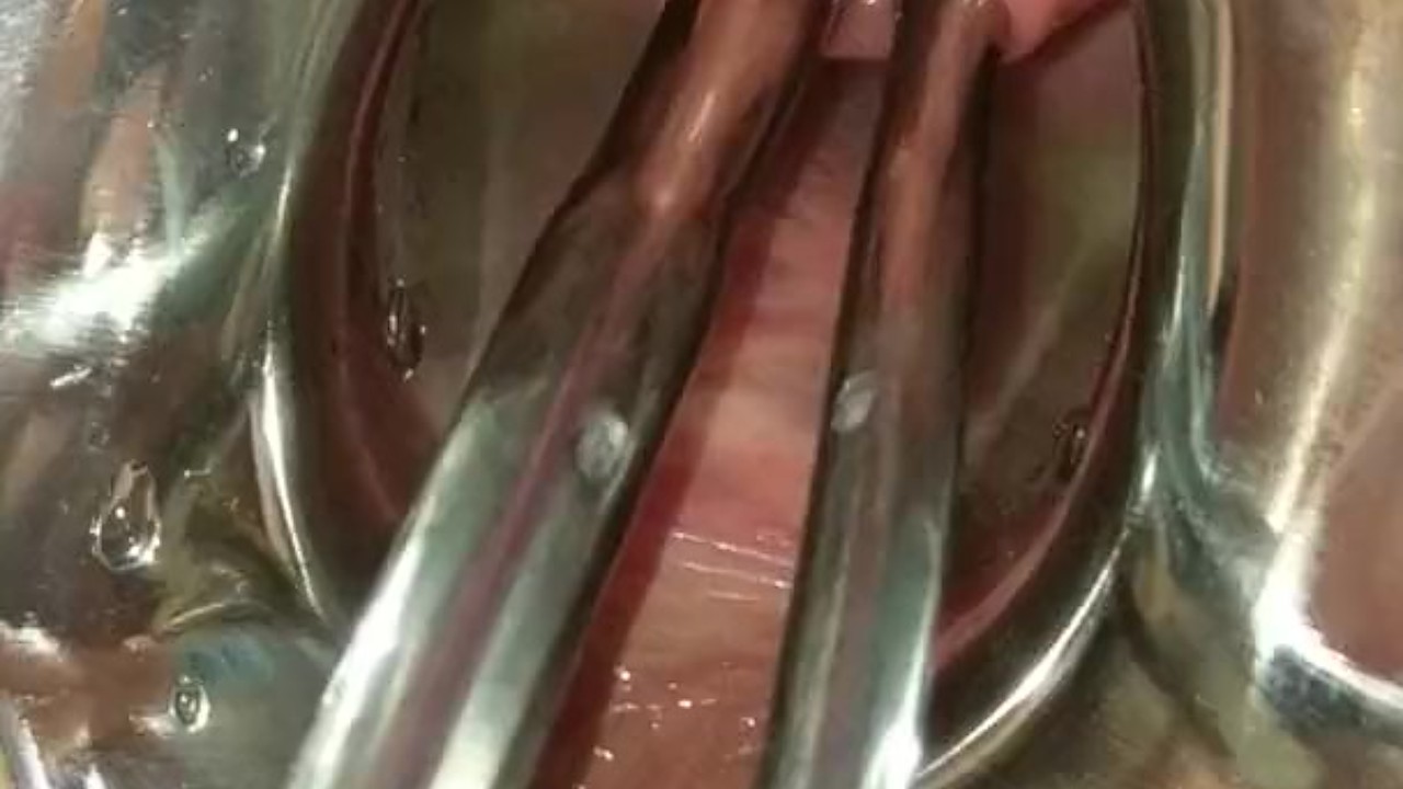 Piss Re Injection Female Urethral Sounding Bdsm Stretched Wide 7850