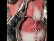 Extreme cervix sounding 11/16