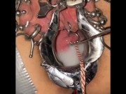 Extreme cervix sounding 14/16