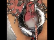 Extreme cervix sounding 15/16