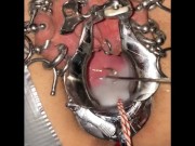 Extreme cervix sounding 16/16