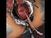 Extreme cervix sounding 4/16