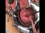 Extreme cervix sounding 6/16