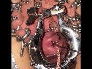 Extreme cervix sounding 7/16