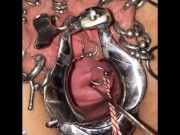 Extreme cervix sounding 8/16