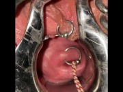 Extreme cervix sounding 9/16