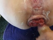 Anal slut gets cock in her huge prolapsed ass 10/16
