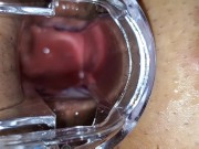 BBW extreme anal and asshole speculum gape 11/16