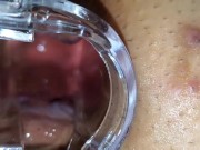 BBW extreme anal and asshole speculum gape 14/16