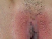 Hair loss on female genitals　脱毛動画　Iラインの毛を抜いてツルツルにします 15/16